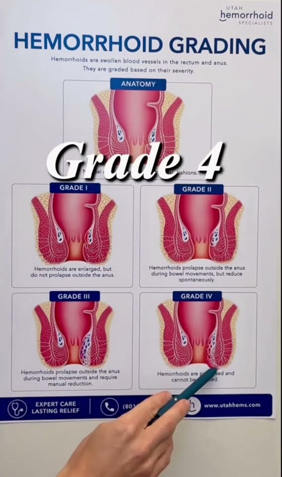 Rachel Hansen, PA-C points to a hemorrhoid grading chart